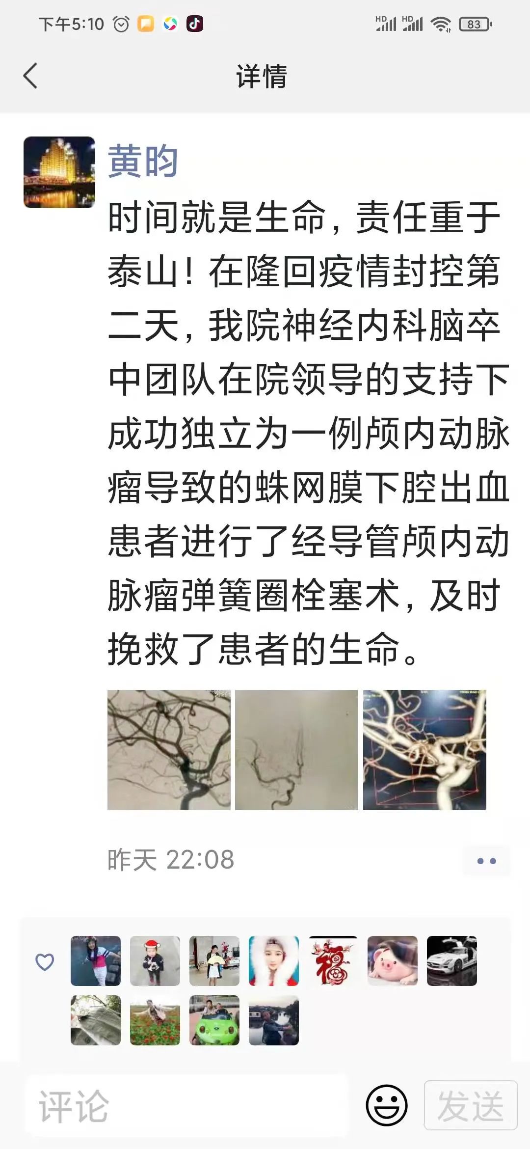隆回人民医院：女子颅内动脉瘤出血头痛如裂，各科联手介入手术保平安