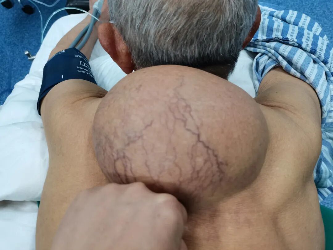 七旬大爷背负罕见巨瘤20年，隆回县人民医院外科专家成功帮他卸下包袱